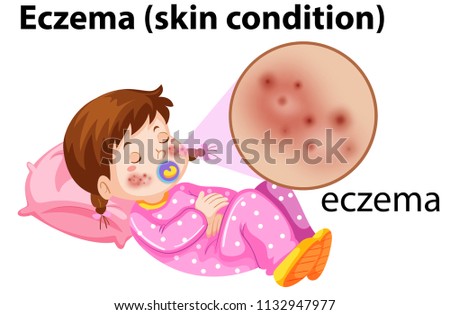 Magnfied eczema on young girl illustration