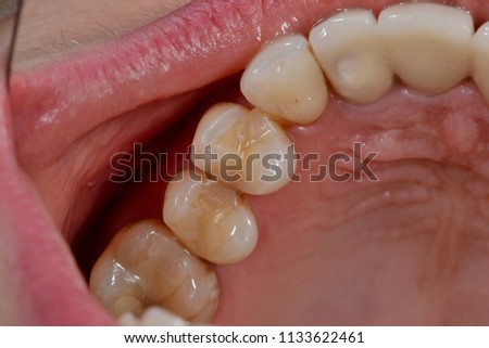 macro dental implantation