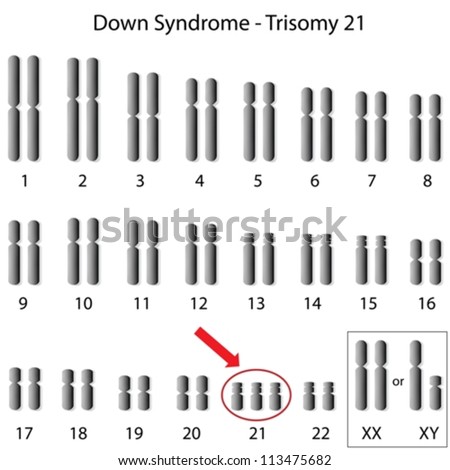 Down syndrome karyotype Royalty-Free Stock Photo #113475682