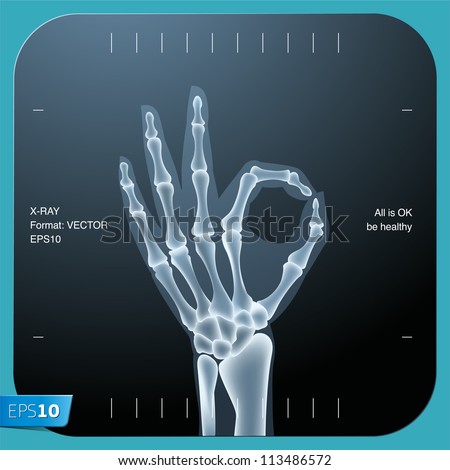X-ray of both human hand (OK!), vector Eps 10 illustration. Royalty-Free Stock Photo #113486572