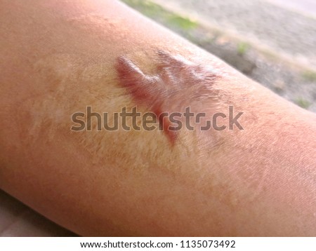 Close up Keloid scar (Hypertrophic Scar) on man arm skin after accident. Royalty-Free Stock Photo #1135073492