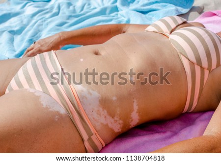 A young woman with vitiligo is suntanning on the beach Royalty-Free Stock Photo #1138704818