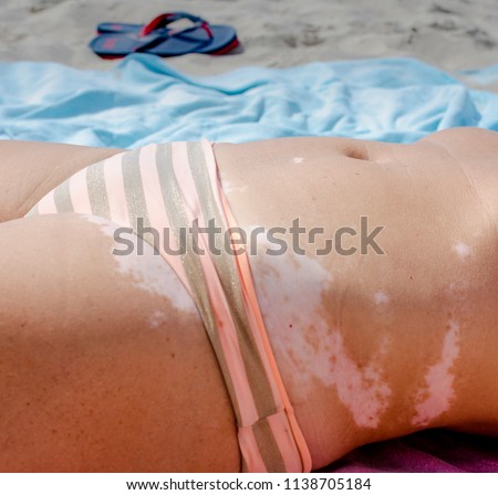 A young woman with vitiligo is suntanning on the beach Royalty-Free Stock Photo #1138705184