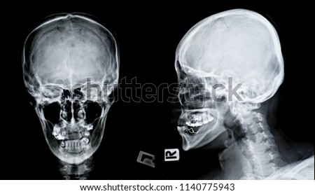  film x-ray skull AP-lateral                                