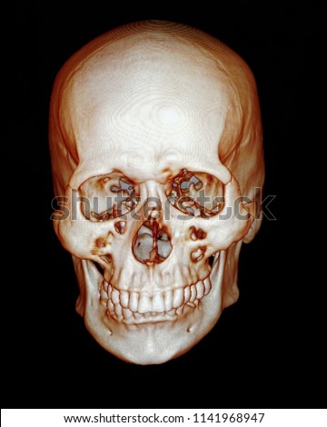 CT scan facial bone 3D of human skull