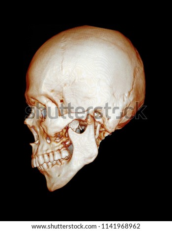 CT scan facial bone 3D of human skull