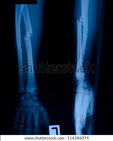 X ray film of proximal radius fracture.