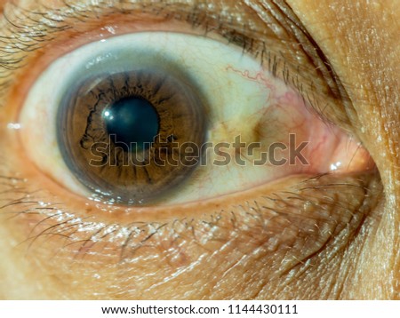 eye macro.human eye.eye.cataract