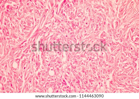 View in microscopic of pathology section ductal cell carcinoma or adenocarcinoma diagnosis by pathologist in laboratory.Criteria of breast cancer.Medical concept.