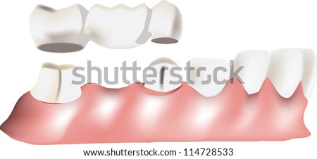 dental bridge Royalty-Free Stock Photo #114728533