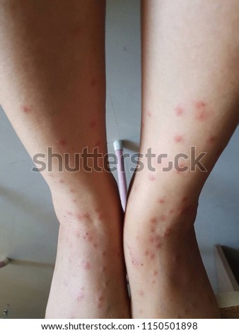 Allergic reactions-blisters, rash and itching due to cat fleas.
