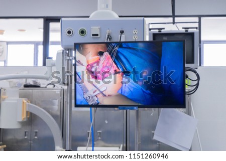 television monitor show picture of Doctors team perform heart surgery at the operating room in the hospital.