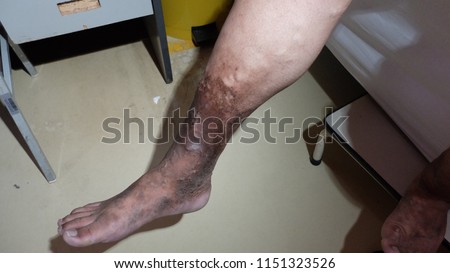 Chronic Venous Insufficiency with Varicose Veins and Hyperpigmented Lower Limb.  Royalty-Free Stock Photo #1151323526
