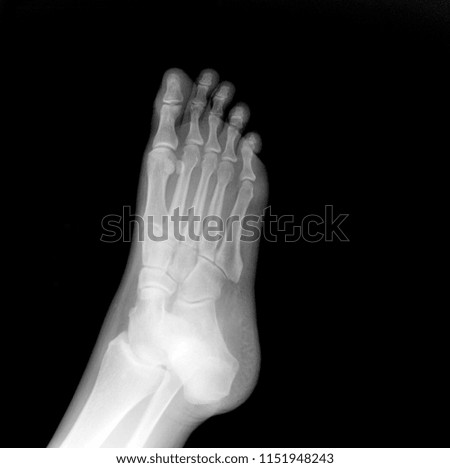X-ray of the foot, lateral part. pain in the foot. doctor's appointment