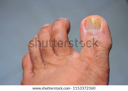 Nail fungus toenail close up on human foot dirty