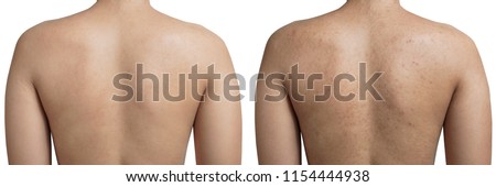 Young Asian woman have acne with red spots on the back and clean back isolated on white background, with clipping path, before and after. Royalty-Free Stock Photo #1154444938