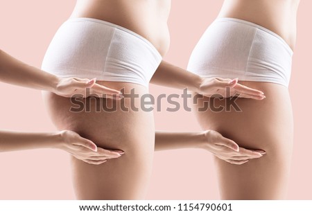 Female hips before and after slimming. Hands shows part with cellulitis on female hips.