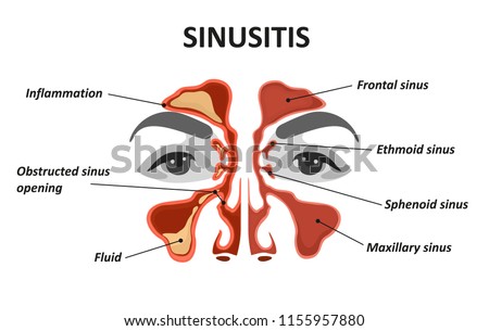 Sinusitis. Healthy and inflammation nasal sinus Royalty-Free Stock Photo #1155957880