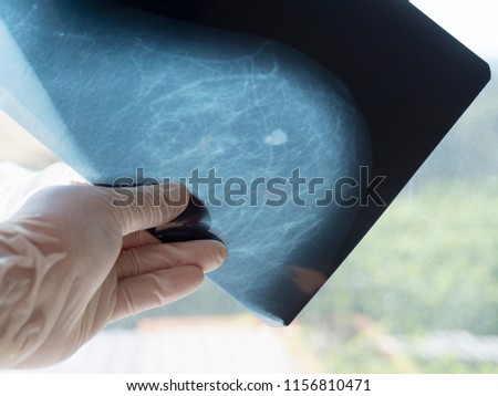 Mammography. The doctor's hand holding the pictures. The doctor examines the pictures in the patient's room.
