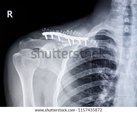  X-ray image of shoulder fracture                             