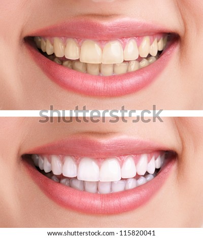 whitening - bleaching treatment ,before and after ,woman teeth and smile, close up, isolated on white Royalty-Free Stock Photo #115820041