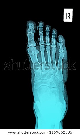 x ray of foot front view.