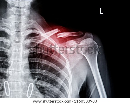 X-ray of shoulder joint show fracture clavicle                                 Royalty-Free Stock Photo #1160333980