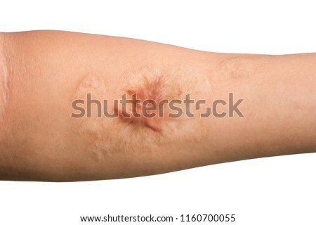 Close up Keloid scar (Hypertrophic Scar) on man arm skin after accident isolated on white background. Royalty-Free Stock Photo #1160700055