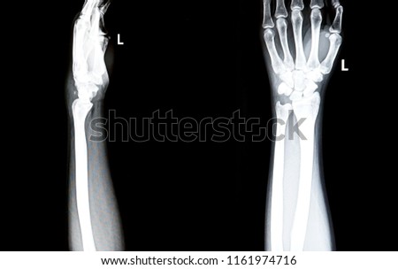  film x-ray wrist                               
