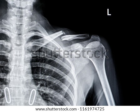 X-ray of shoulder joint show fracture clavicle                                 Royalty-Free Stock Photo #1161974725