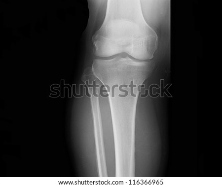 X-ray picture showing knee joints