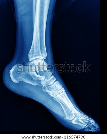 x-ray of foot