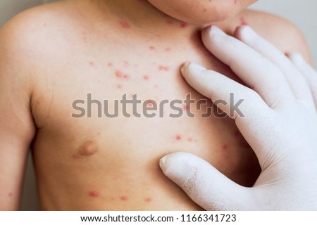 Virus of varicella .Doctor and child. Red rashes on the baby's body. Viral Diseases Royalty-Free Stock Photo #1166341723