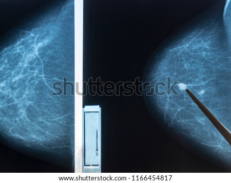 Mammography. The doctor examines pictures of a patient with fibroadenomatosis.