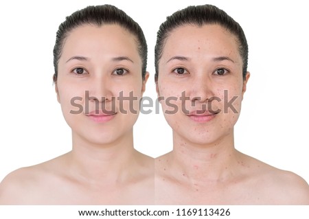 Beautiful young  woman with and without aging signs wrinkles, blemishes, mole. Before and after laser treatment or plastic procedure, anti-age therapy.
