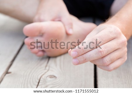 Young man's hand showing wooden splinter after removing it from foot. Accident on wooden floor after walking by barefoot. Front view. Close up. Royalty-Free Stock Photo #1171555012