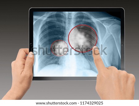 Close-up Of Woman Holding Digital Tablet - X-ray of human cancer lungs