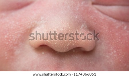 Macro, close-up shot of the milia on a two day old baby cheek
, nose and forehead. Royalty-Free Stock Photo #1174366051