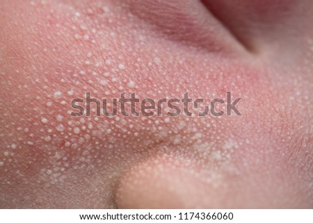 Macro, close-up shot of the milia on a two day old baby cheek
, nose and forehead. Royalty-Free Stock Photo #1174366060