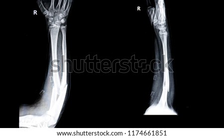  film x-ray forearm AP : show fracture                              