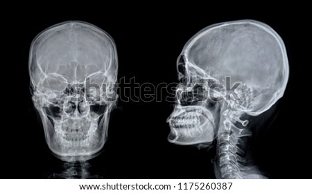   X-ray image of skull
                             
