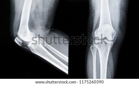  film X-ray image Knee
                              