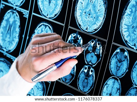 Doctor pointing with pen to the brain Royalty-Free Stock Photo #1176078337