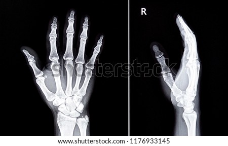X-Ray image of human hand                                Royalty-Free Stock Photo #1176933145