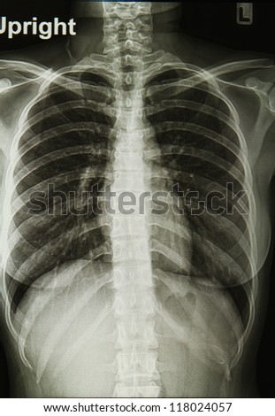 chest X-rays image ,lungs image