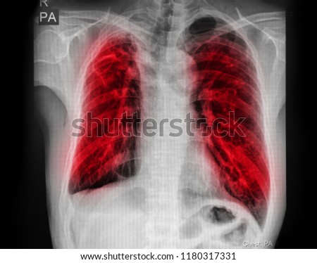 Pulmonary Tuberculosis ( TB ) : Chest x-ray show alveolar infiltration at both lung due to mycobacterium tuberculosis infection.
