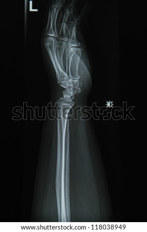 forearm  x-ray image left side