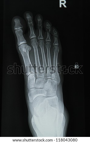 ankle and foot x-rays image