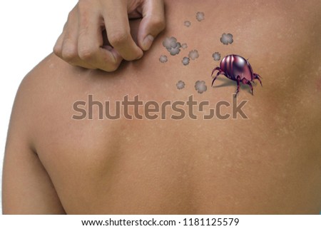Picture dust mites, skin rashes from dust mite