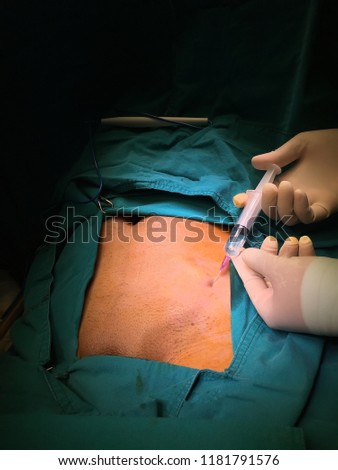 surgeon is injecting lidocaine to inguinal region before hernia surgery 